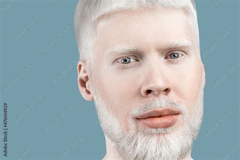Albinism Concept Portrait Of Young Bearded Albino Man With White Hair