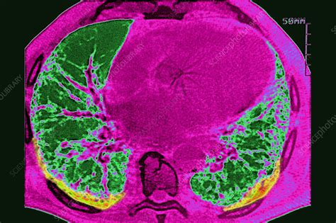 Asbestosis Ct Scan Stock Image C0448791 Science Photo Library