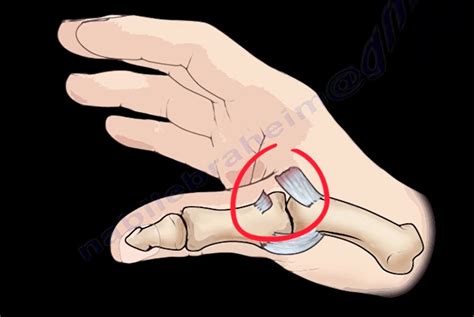 Ulnar Collateral Ligament Injury Of Thumb Orthopaedicprinciples Com