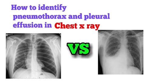 Pleural effusion is fluid buildup in the space between the layers of the pleura. How to // identify // pneumothorax // and // pleural ...