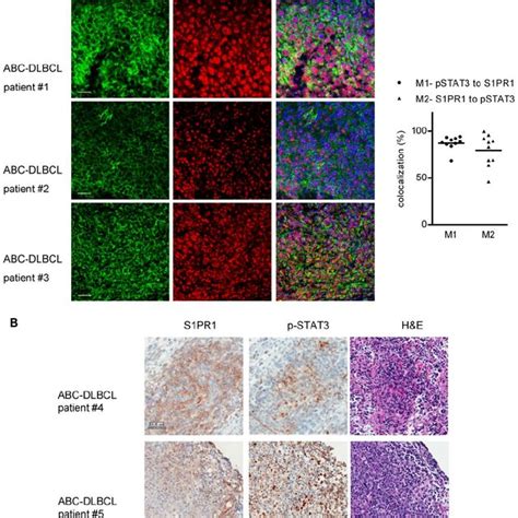 Coexpression Of S1pr1 And Phospho Stat3 In Abc Dlbcl Patient Tumor