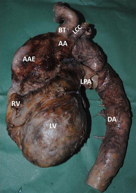 Sternocostal Surface Of Heart Note The Thoracic Aortic