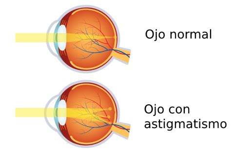 Orto K con astigmatismo Sí es posible Centro de Miopía Fernández