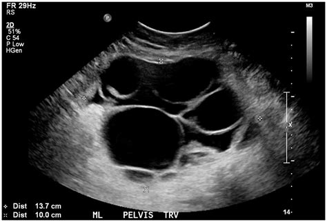 Serous Cystadenocarcinoma Ultrasound