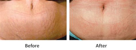 How Can I Minimise The Stretchmarks On My Tummy And Hips Myskinandco