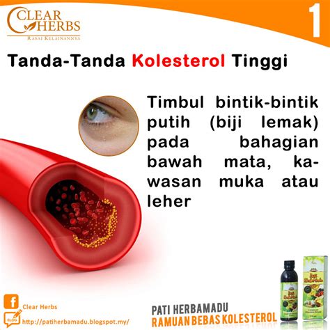 Namun demikian, ada tanda umum pada penderita kebanyakan. Pati HerbaMadu: Tanda-tanda Kolesterol Tinggi