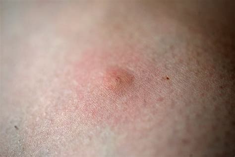 How To Prevent And Treat Chigger Bites Lady Lees Home