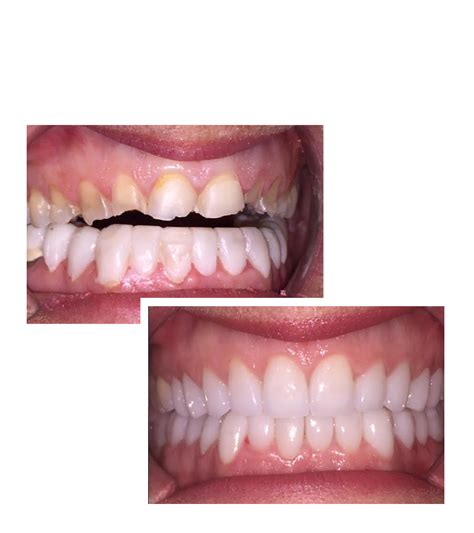Full Mouth Reconstruction Nashville Tn Gulch Dental Studio Dentist