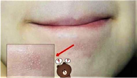 Pada waktu terjadi perubahan hormon pada masa remaja atau. Tahukah Kenapa Ada Bintik-bintik Kecil Di Bawah Mulut Atau ...