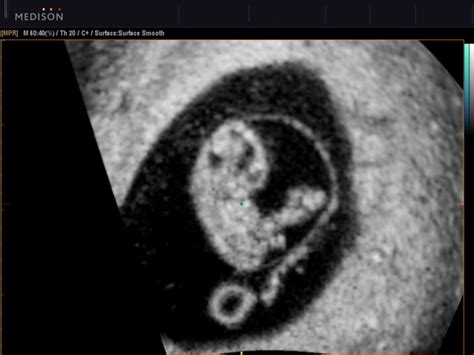 Until now, it's been safe to put off any thought of an ultrasound, but week 8 is the time to start making plans. Ultrasound images - Fetus, 8 weeks, coronal image (№517 ...