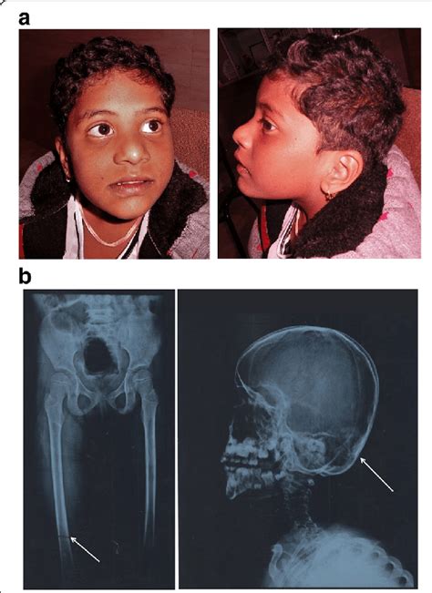 An epicanthic fold, epicanthal fold, or epicanthus is a skin fold of the upper eyelid (from the nose to the inner side of the eyebrow) covering the inner i think the peculiarities are caused by the nasal root, which appears to be unusually broad and flat. Flat Nasal Bridge And Epicanthal Folds / Foetal Alcohol ...