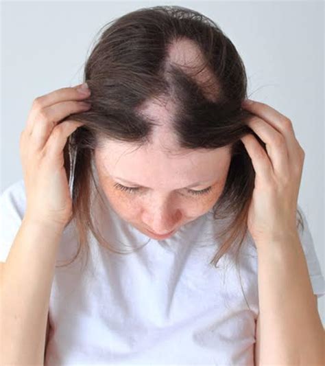 Top More Than 78 Hair Pulling Disorder Super Hot Ineteachers