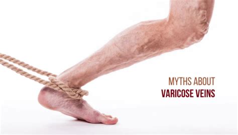 10 Myths About Varicose Veins That You Should Not Believe Dr Abhilash