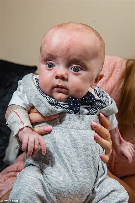 Baby Born Without Any Skin On Its Body Defies Doctors Grim Prognosis