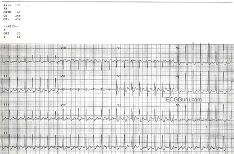 Paroxysmal Supraventricular Tachycardia Ecg