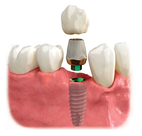 Implant With Crown Rocky Mount Nc Denturecare And Implant Solutions