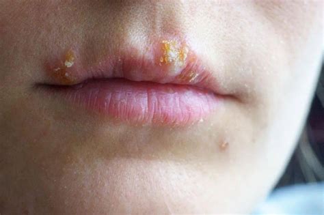 If You Have Blisters Or Rashes On Your Mouth Dont Be Bothered By It