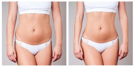 Trusculpt Id Your Answer To Getting Rid Of Stubborn Fat The Ob Gyn Center Obgyns