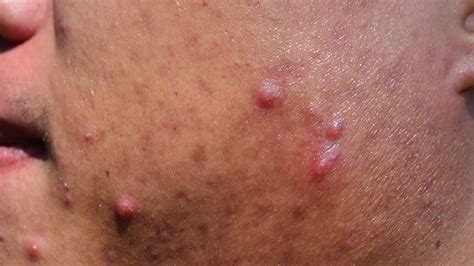 Acne Symptoms Causes Diagnosis Treatment And Prevention Edoms Health