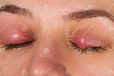 Upper Eyelid Infection Chalazion Stock Photo Image Of Abscess Pain