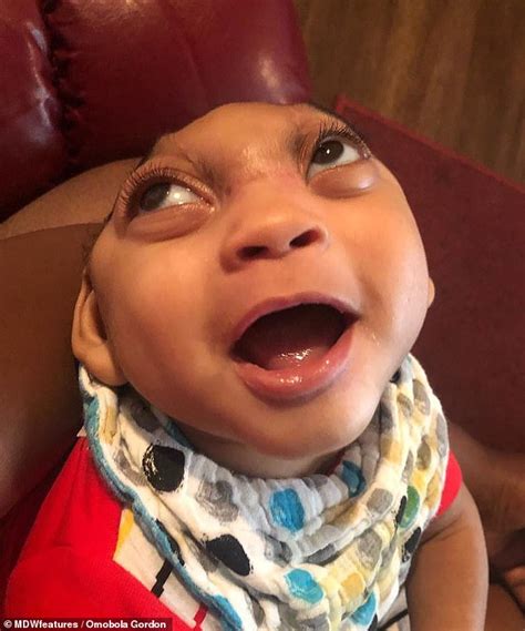 Baby Born With A Tiny Head And Part Of His Brain Sticking Out From His