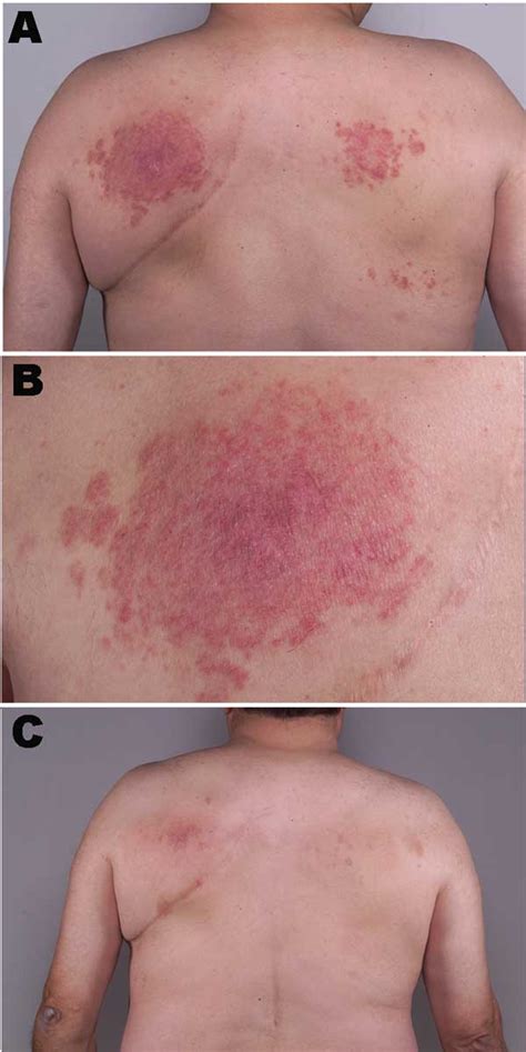 Figure Mycobacterium Intermedium Granulomatous Dermatitis From Hot