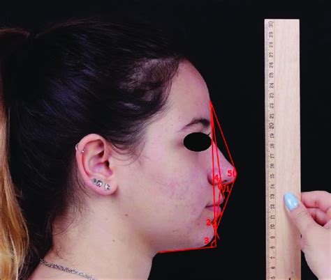 Angular Measurements On Facial Profile Photographs 1 Nasolabial