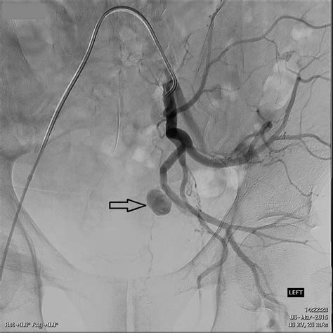 Endovascular Angiogram Of The Left Internal Iliac Artery Demonstrating