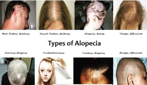 Acute skin disease called eczema affects the scalp. The Different Types of Alopecia Hair Loss ...