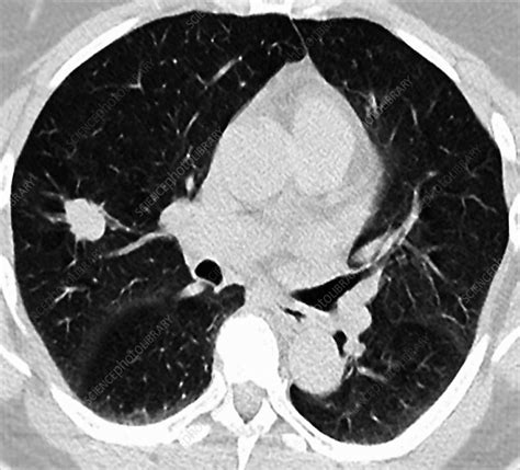 Lung Cancer Ct Scan Stock Image C0212513 Science