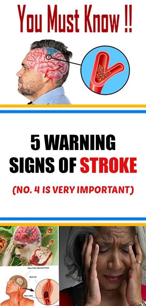 5 Signs Of Stroke