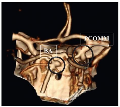 Young patients who experience basal ganglia hemorrhage should have. Cerebral Aneurysms | Nurse Key
