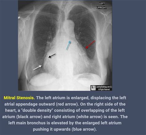 Chest X Ray Findings Of Mitral Stenosis Medizzy