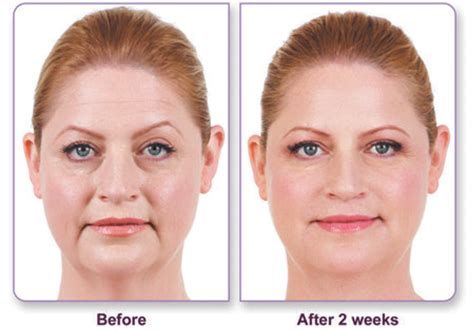 Juvederm May Help Correct Your Nasolabial Folds Without Surgery