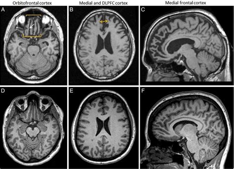 The behavioural variant frontotemporal dementia (bvFTD) syndrome in ...