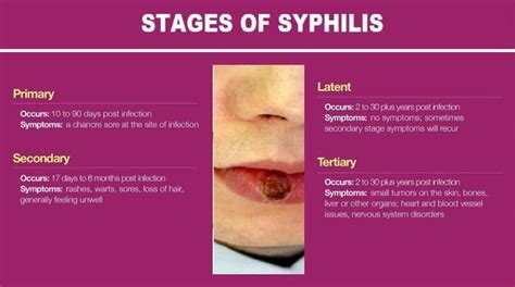 Syphilis Infection Symptoms And Stages Helal Medical
