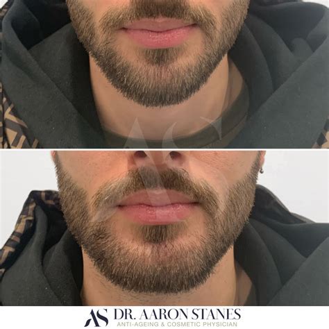 Male Chin Example 8 Dr Aaron Stanes Anti Ageing And Cosmetic Medicine
