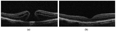 Jcm Free Full Text Outcomes Of Vitrectomy For Long Duration Macular