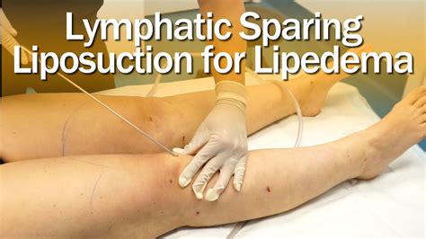 Lipedema Liposuction Surgery Lymphatic Sparing Expert Dr Thomas Su