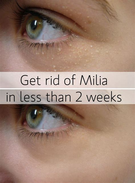 How To Remove Milia In Eyelid Howotremvo
