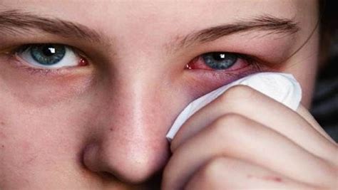 Eye Redness And How To Treat It