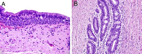 Hpv Driven Anal Neoplasia Review And Recent Developments Pathology