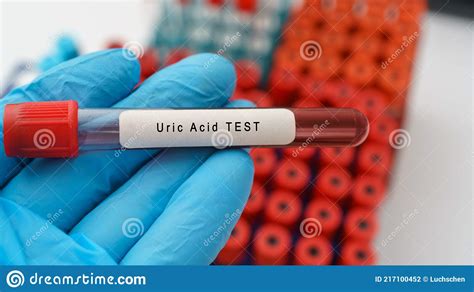 Uric Acid Test Result With Blood Sample In Test Tube On Doctor Hand In