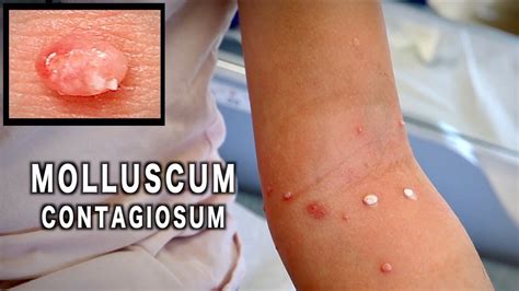 Unusual Molluscum Contagiosum Treated With Cryotherapy Dr Paul