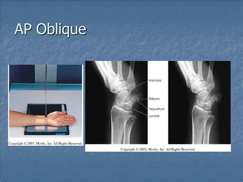 Wrist Ap Oblique X Ray Polymed Lab