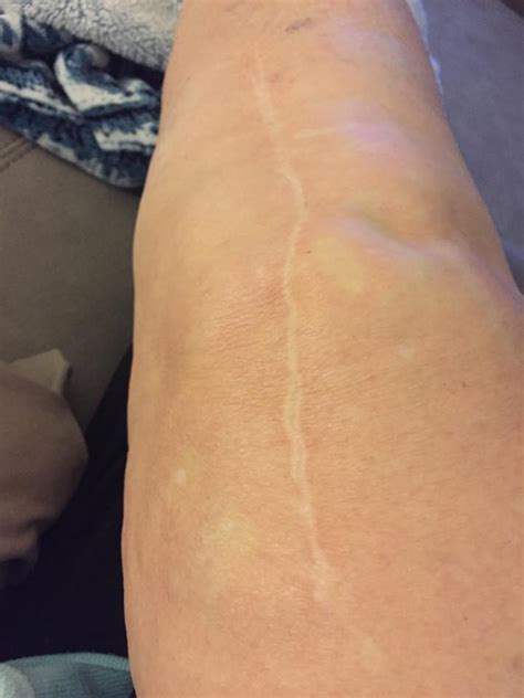 Knee Replacement Scar Recovery Timeline A Photo Gallery