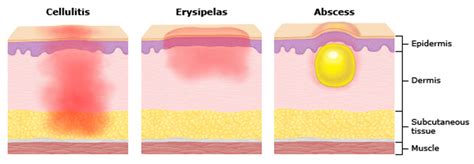 Cellulitis Vs Erysipelas