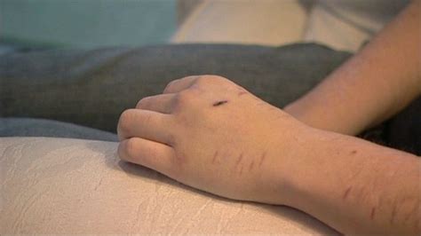 Children Self Harming Hospital Admissions Rise In Kent Bbc News