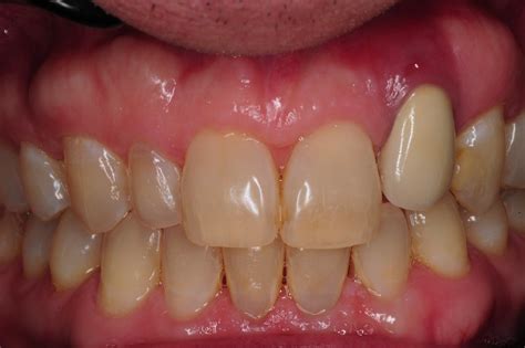 Two Common Causes For Gum Recession And Infection On Dental Implants