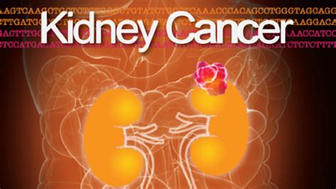 Kidney Cancer Journal Archives Grand Rounds In Urology